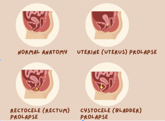 Pelvic Health And You: Newsletter #5 Prolapse 3 00de184 031 0260 2d37 4780364fd4fd image 1